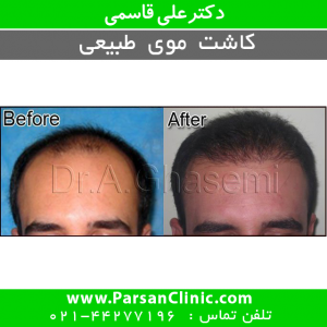  مراقبت های پس از کاشت مو