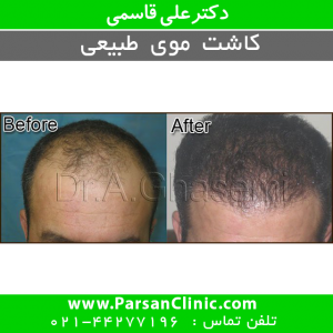 عمل کاشت مو