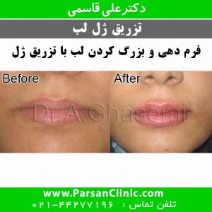تزریق ژل