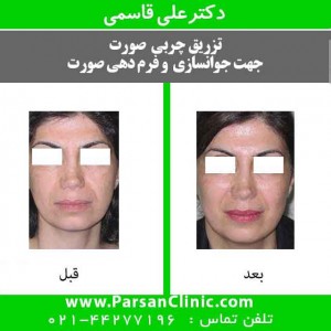 تزریق چربی