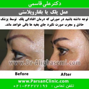 عمل پلک (1)