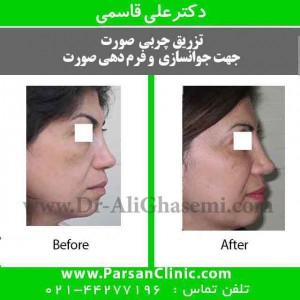 عمل-چربی-به-صورت-