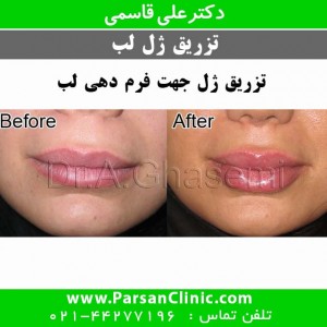فرم دهی لب