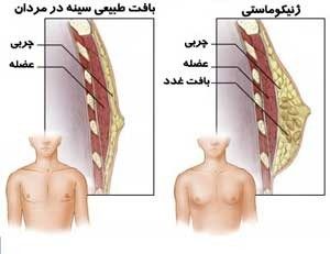 لیپوماتیک سینه آقابان