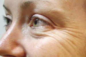 تزریق چربی دور چشم