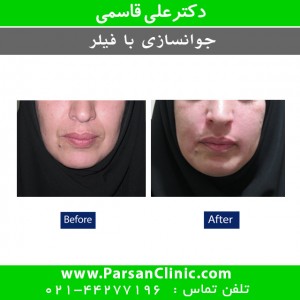 تزریق ژل به خط خنده 