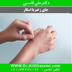 درمان اسکار