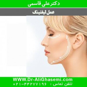 لیفتینگ صورت با نخ کاگ