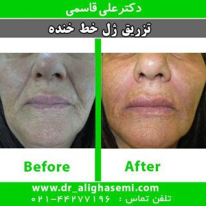 تزریق ژل به خط خنده 