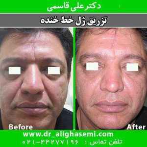 تزریق ژل به خط خنده 