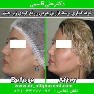 تزریق چربی