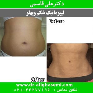 لیپوماتیک