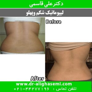 لیپوماتیک