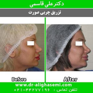 تزریق چربی
