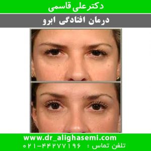 بالا کشیدن ابرو