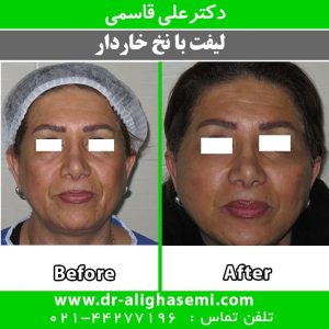 مراقبت های بعد از لیفت صورت با نخ