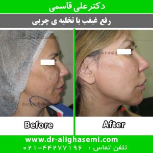 رفع غبغب با تخلیه ی چربی