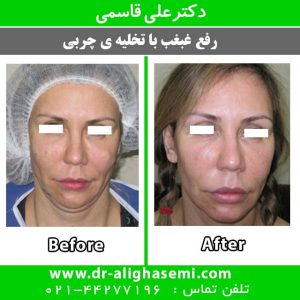 رفع غبغب با تخلیه ی چربی
