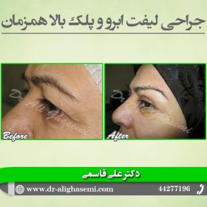جراحی لیفت ابرو 